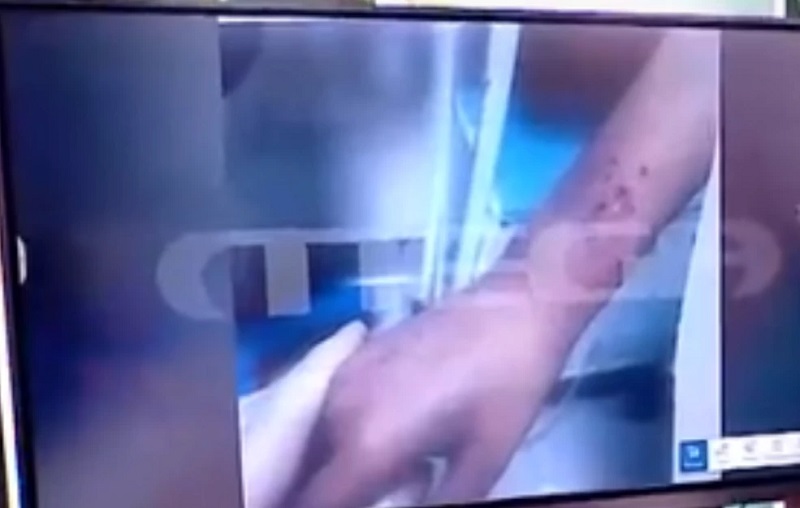 Ανατριχίλα προκαλούν οι εικόνες με τις πληγές στα δύο αδελφάκια στη Λάρισα