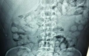 Αλλοδαπός είχε καταπιεί 100 «αυγά» κοκαΐνης και πιάστηκε στο αεροδρόμιο «Ελευθέριος Βενιζέλος»