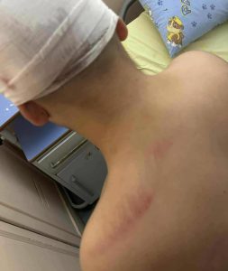 Ξυλοδαρμός 13χρονου: Δίωξη για απόπειρα ανθρωποκτονίας στον 18χρονο που συνελήφθη