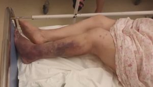 Γηροκομείο κολαστήριο: 89χρονη κατέληξε από άγρια κακοποίηση