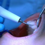 Ένα τζελ νικά την τερηδόνα: Το «Άγιο Δισκοπότηρο» της οδοντιατρικής