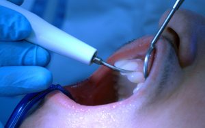 Ένα τζελ νικά την τερηδόνα: Το «Άγιο Δισκοπότηρο» της οδοντιατρικής