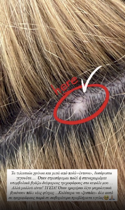 Ιωάννα Τούνη: Η τριχοφάγος που της προκάλεσε το στρες