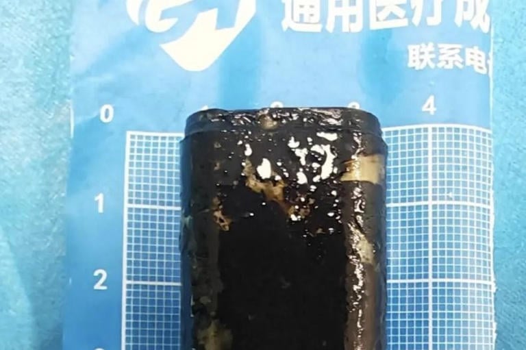 Κίνα: Κατάπιε αναπτήρα πριν 30 χρόνια – Ακόμα λειτουργούσε στο στομάχι του