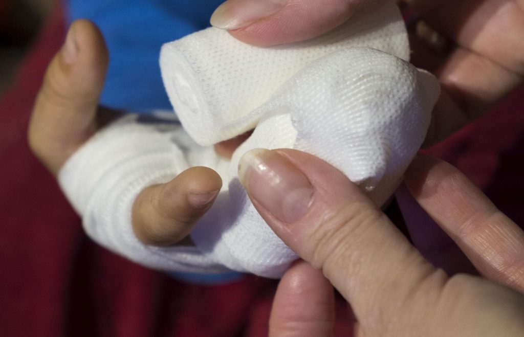 Πτολεμαΐδα: Σοβαρός τραυματισμός 17χρονου - Κροτίδα εξερράγη στα χέρια του