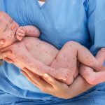 Έξαρση ιλαράς στην Ευρώπη και ανησυχία για την Ελλάδα – Τι λένε οι ειδικοί